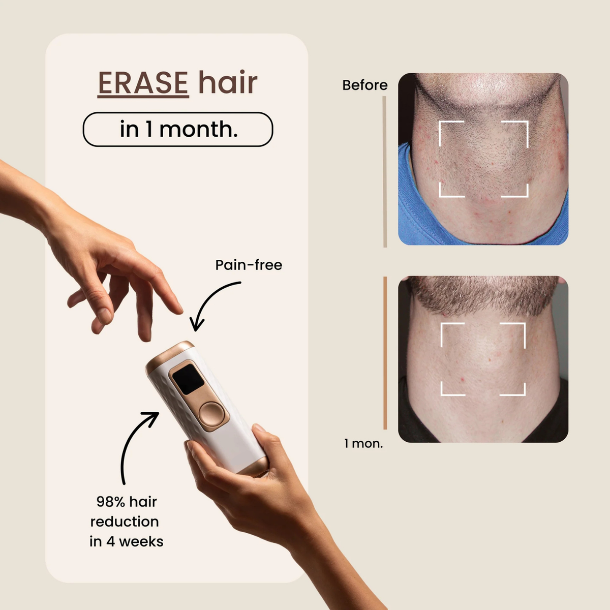 ICE IPL at home laser